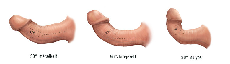 Phasen der Peyronie-Krankheit nach dem Ausmaß der Krümmung
